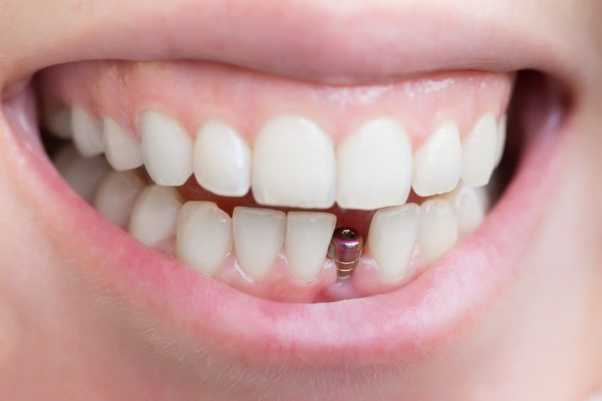 Зачем обращаться в квалифицированную клинику для протезирования зубов