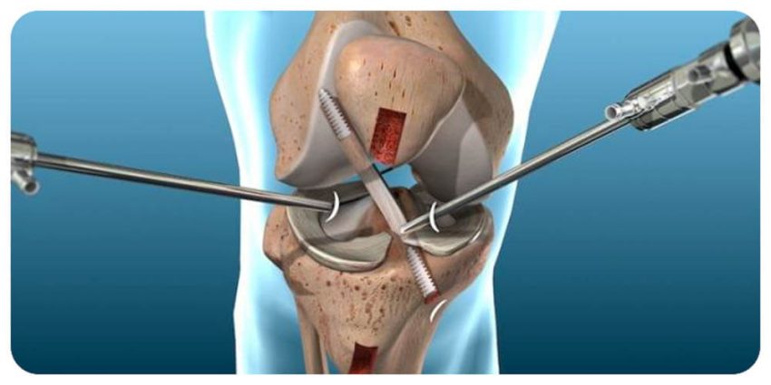 Артроскопия коленного сустава: преимущества квалифицированных услуг